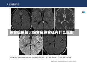 综合症疫情，综合症综合征有什么区别-第2张图片