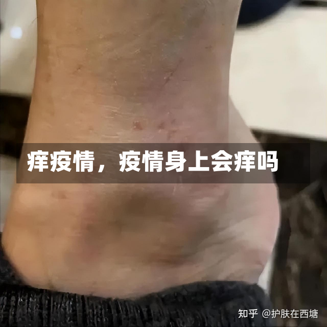 痒疫情，疫情身上会痒吗